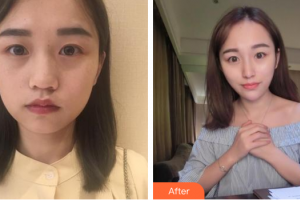 廣州可玉醫(yī)療美容門診部劉瑤整形價格表附熱瑪吉多方面部體驗案例展示