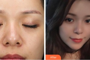 杭州東方整形外科門診部萬夢華整形價格表附熱拉提案例展示