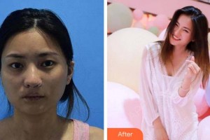 杭州啟美醫(yī)療美容醫(yī)院苗強(qiáng)整形價格表附埋線提升案例展示