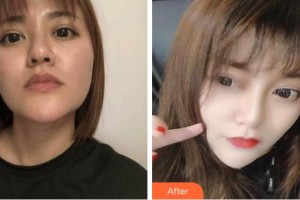 杭州藝星醫(yī)療美容醫(yī)院譚琳整形價格表附埋線提升案例展示