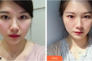 杭州藝星醫(yī)療美容醫(yī)院朱慧芳整形價格表附埋線提升案例展示