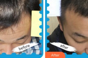 杭州科發(fā)源帝麥整形醫(yī)院閉陸祥整形價格表附植發(fā)養(yǎng)發(fā)案例展示