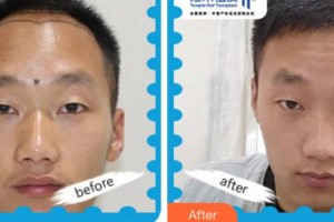 杭州科發(fā)源帝麥整形醫(yī)院李興東整形價格表附植發(fā)養(yǎng)發(fā)案例展示