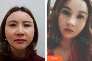 杭州瑞麗整形醫(yī)院吳艾競整形價格表附埋線提升案例展示