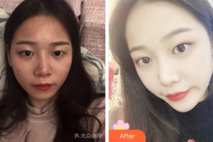 杭州維多利亞醫(yī)療美容醫(yī)院馬騰整形價格表附切開雙眼皮案例展示