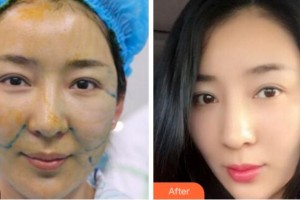 杭州維多利亞醫(yī)療美容醫(yī)院李鶯整形價格表附埋線提升案例展示