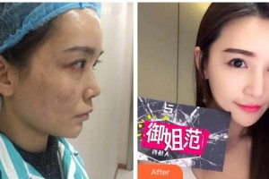 杭州維多利亞醫(yī)療美容醫(yī)院朱蕓整形價格表附激光祛斑案例展示