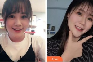 杭州維多利亞醫(yī)療美容醫(yī)院施長溪整形價格表附金屬托槽矯正案例展示