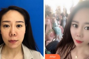 杭州維多利亞醫(yī)療美容醫(yī)院劉毅整形價格表附埋線提升案例展示