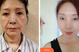 杭州東方整形外科門診部魏端欽整形價格表附埋線提升案例展示