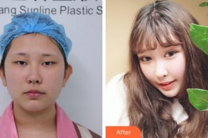 杭州格萊美整形美容醫(yī)院孫商燮整形價格表附切開雙眼皮案例展示