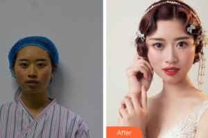 杭州格萊美整形美容醫(yī)院王雪瑞整形價格表附埋線提升案例展示