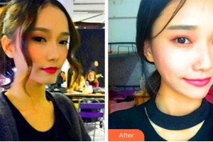 杭州格萊美整形美容醫(yī)院張龍整形價格表附熱瑪吉案例展示