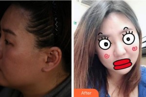 杭州時光醫(yī)療美容醫(yī)院鄭曉輝整形價格表附埋線提升案例展示