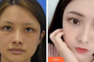 杭州珍美顏醫(yī)療美容診所賈恩榮整形價格表附埋線提升案例展示