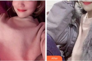 杭州美萊醫(yī)療美容醫(yī)院姜貴杰整形價格表附超聲波潔牙案例展示