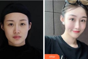 杭州靜港醫(yī)療美容診所程衛(wèi)民整形價格表附埋線提升案例展示