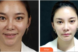 杭州時光醫(yī)療美容醫(yī)院KevinTeng整形價格表附埋線提升案例展示