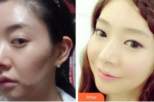 杭州格萊美整形美容醫(yī)院劉魏魏整形價格表附埋線提升案例展示