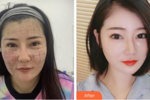 杭州藝星醫(yī)療美容醫(yī)院付德剛整形價格表附熱瑪吉案例展示