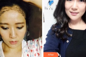 杭州雍禾植發(fā)醫(yī)院張東宏整形價格表附種植發(fā)際線案例展示