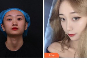杭州韓佳醫(yī)療整形門診部樸相恩整形價格表附鼻部綜合案例展示