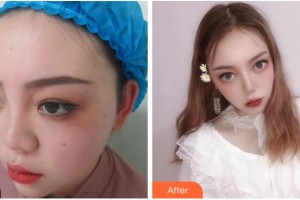 杭州韓佳醫(yī)療整形門診部柳垣在整形價格表附鼻部綜合案例展示