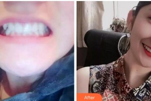 杭州維多利亞醫(yī)療美容醫(yī)院吳品芳整形價格表附牙齒隱形矯正案例展示