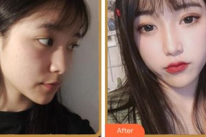 杭州顏術悅容醫(yī)療美容診所蘭巖菊整形價格表附埋線提升案例展示