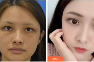 杭州顏術悅容醫(yī)療美容診所嚴后友整形價格表附埋線提升案例展示