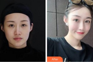 杭州顏術悅容醫(yī)療美容診所黃珊珊整形價格表附埋線提升案例展示