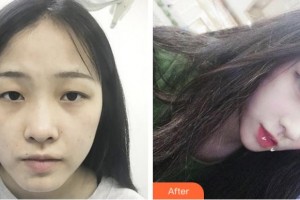 杭州珍美顏醫(yī)療美容診所沈明強整形價格表附切開雙眼皮案例展示