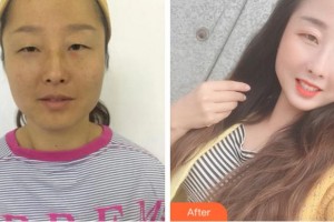 杭州黛雅醫(yī)療美容診所何冬梅整形價格表附內切祛眼袋案例展示