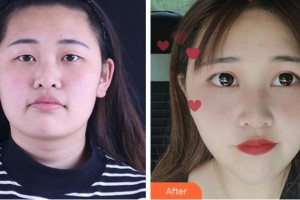 杭州麗欣醫(yī)療美醫(yī)院柯澤紅整形價格表附眼部綜合案例展示