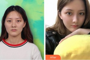 杭州昕微整形美容醫(yī)院漆淳整形價格表附內切祛眼袋案例展示