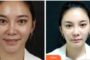 杭州時光醫(yī)療美容醫(yī)院鄭曉暉整形價格表附埋線提升案例展示