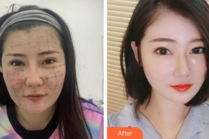 杭州麗星醫(yī)療美容診所金榮敏整形價格表附熱瑪吉案例展示