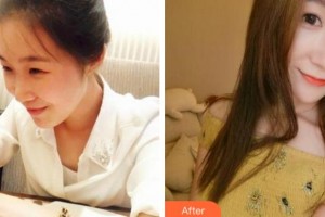 杭州麗星醫(yī)療美容診所鄭心媛整形價格表附熱瑪吉案例展示