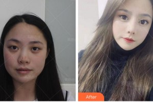 杭州善慈醫(yī)療美容診所曾舉整形價格表附假體隆鼻案例展示