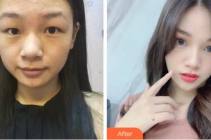 杭州朝聚眼科醫(yī)院金姬整形價(jià)格表附切開雙眼皮案例展示