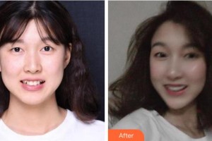 杭州美奧口腔門診部黃肖整形價(jià)格表附牙齒隱形矯正案例展示