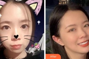 杭州富陽柏氏眼科醫(yī)院柏硯農(nóng)整形價(jià)格表附金屬托槽矯正案例展示