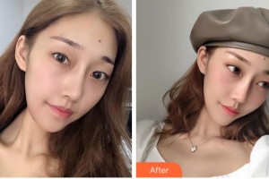 杭州求是眼科醫(yī)院劉文群整形價(jià)格表附眼部綜合案例展示