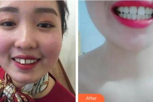 義烏杭州口腔門診部陳海英整形價(jià)格表附牙齒隱形矯正案例展示