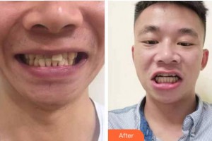 義烏杭州口腔門診部朱保民整形價(jià)格表附牙齒隱形矯正案例展示