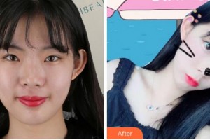 杭州薇琳醫(yī)療美容醫(yī)院劉淑芹整形價(jià)格表附熱瑪吉案例展示