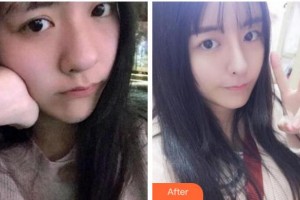 杭州依萱綺醫(yī)療美容診所周琦整形價格表附熱瑪吉案例展示