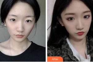 杭州華廈眼科醫(yī)院李夏珍整形價格表附切開雙眼皮案例展示