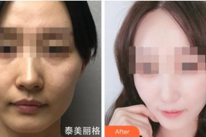杭州睿妍醫(yī)療美容診所司婷婷整形價格表附熱瑪吉案例展示