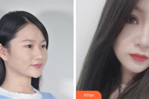 杭州求是眼科醫(yī)院平整形價格表附眼部綜合案例展示